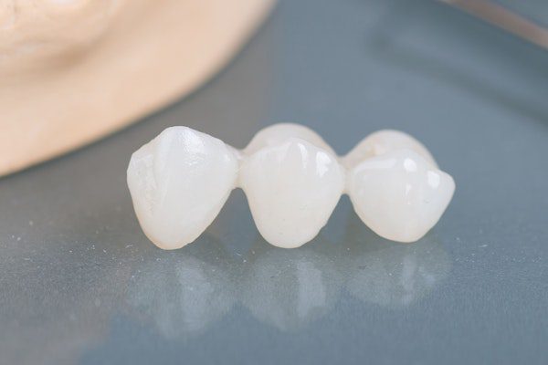 Ceramic dental bridge close-up
