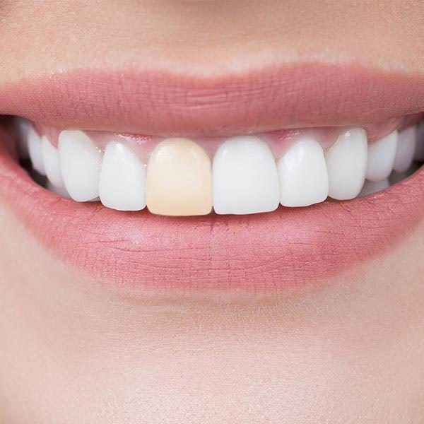 Teeth with one discolored tooth