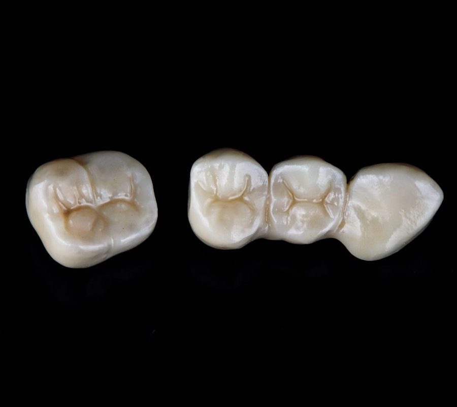 Three dental crowns in a row
