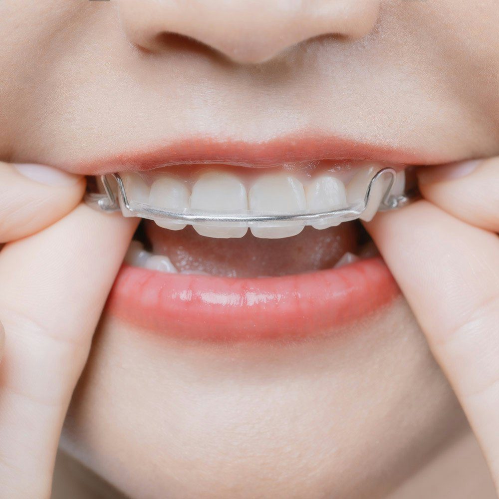 Hands holding orthodontic appliance