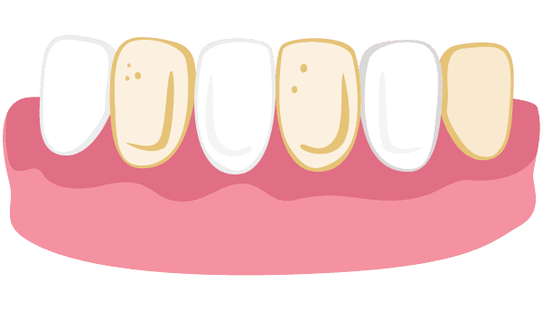 Cartoon teeth showing yellow discoloration