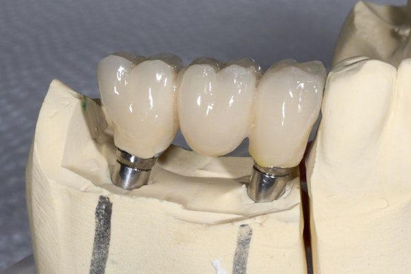 Three dental crowns on model