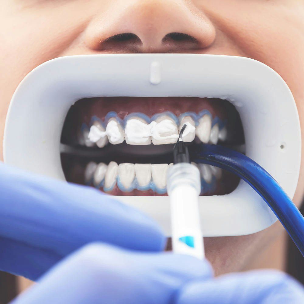 Professional teeth bleaching process