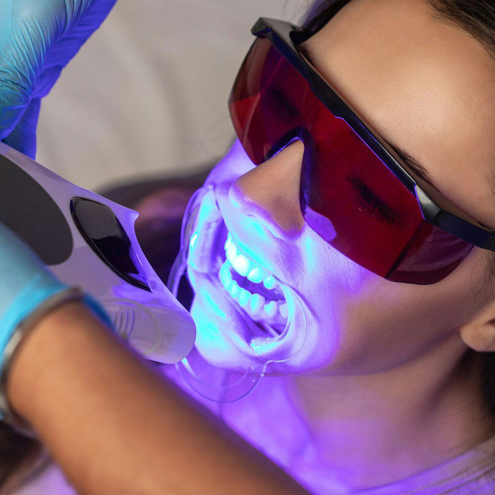Teeth whitening procedure with UV light