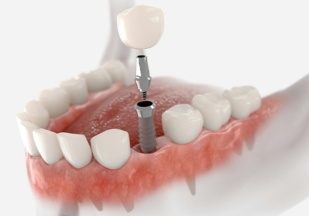 Tooth implant procedure with gum and implant